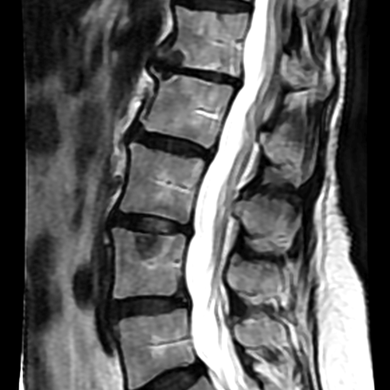 脊柱 MRI 原图